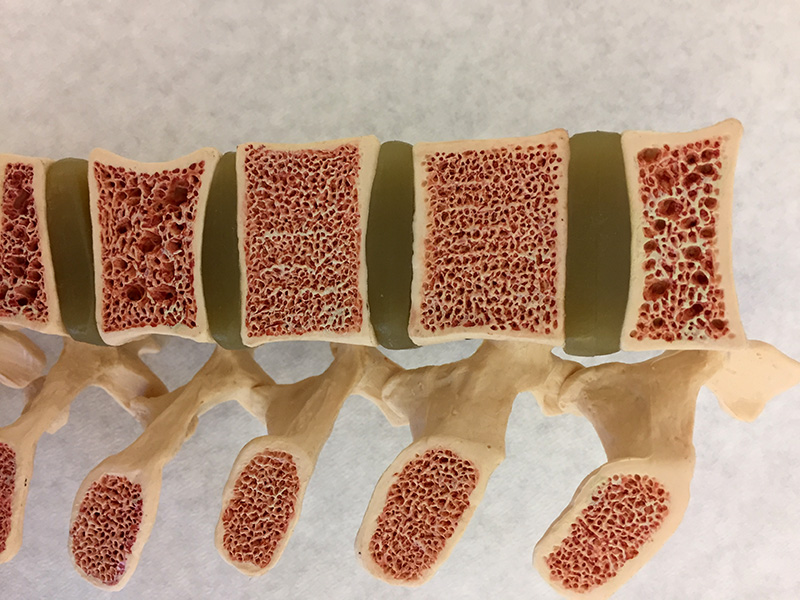 Una foto de un modelo médico muestra secciones a través de cinco vértebras, revelando la matriz ósea interna de color rosa. Algunas de las vértebras tienen agujeros más grandes que otras.