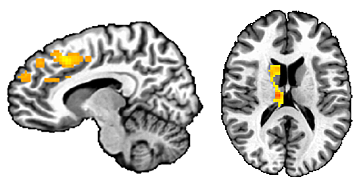 Imágenes de estudios de IRMf que muestran dos vistas del cerebro, como un “corte” vertical visto de lado y como un corte horizontal. Las partes activas del cerebro se iluminan en amarillo y rojo.