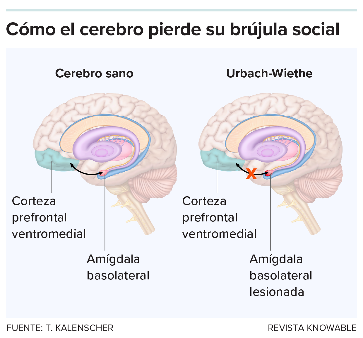 Un gráfico compara el funcionamiento en la toma de decisiones sociales en el cerebro de una persona con la enfermedad de Urbach-Wiethe y en un cerebro normal.