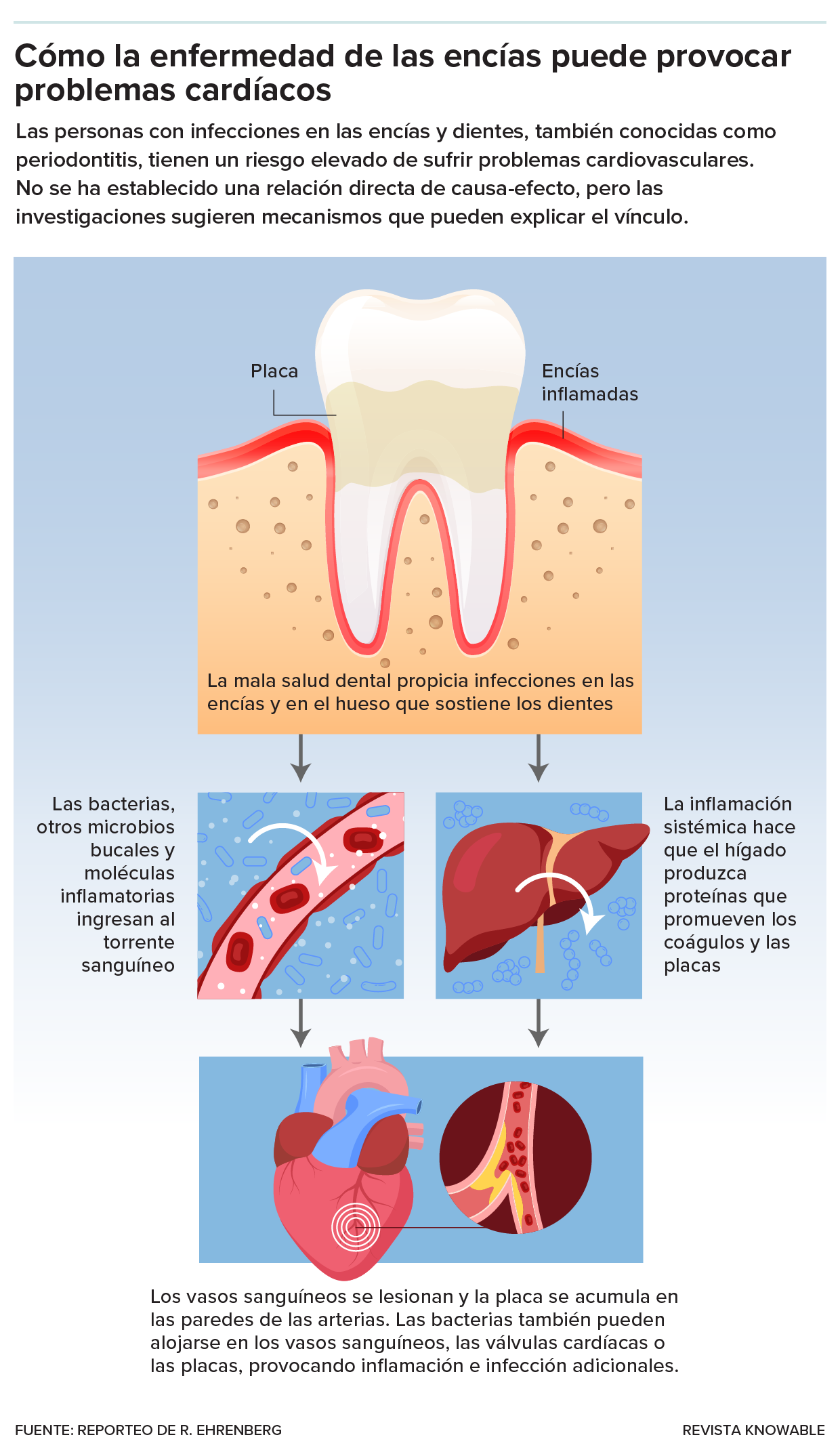 El gráfico muestra cómo la inflamación crónica en la boca y las bacterias orales podrían provocar problemas cardiovasculares.