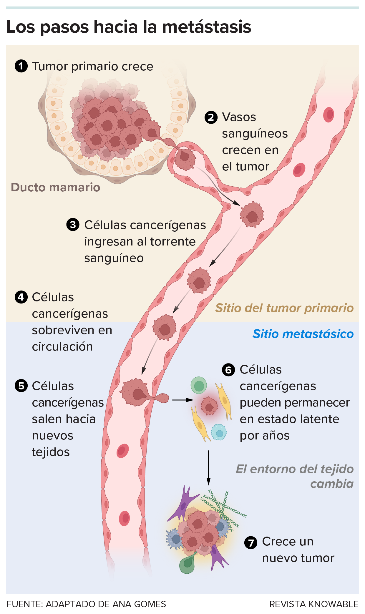 Muchos pasos hacia la metástasis Un diagrama ilustra cómo una célula cancerosa abandona un tumor de mama y viaja a través del torrente sanguíneo a un nuevo lugar para formar un tumor metastásico.