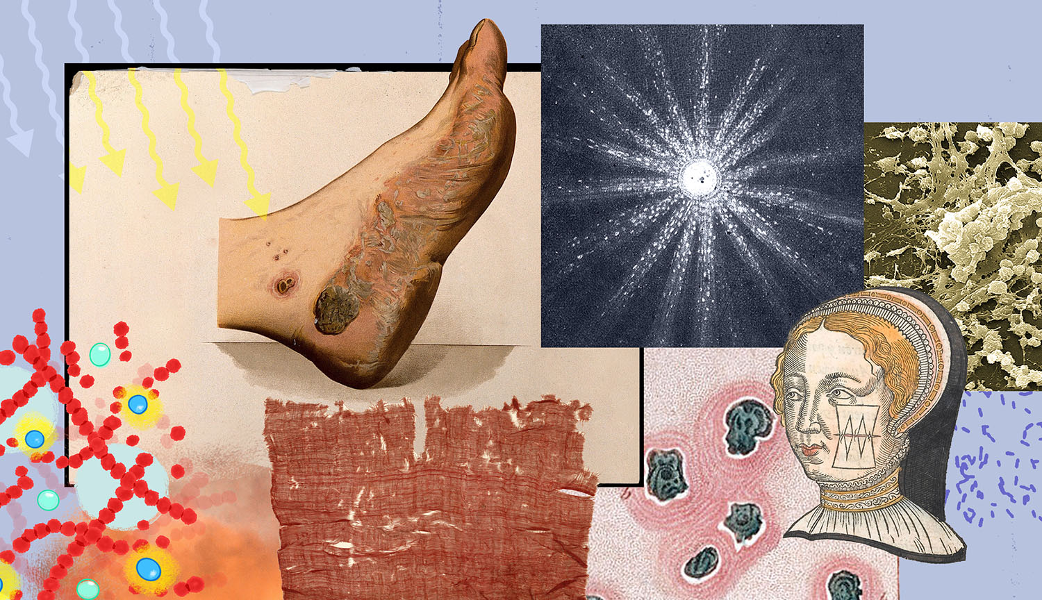 Ilustración que muestra heridas infectadas, bacterias y luz.