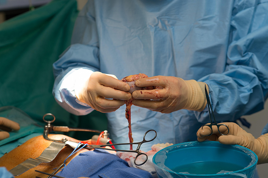 Fotografía de una operación de trasplante de riñón, con un cirujano con bata y guantes azules sosteniendo un riñón sobre una cavidad corporal abierta, con varias pinzas metálicas visibles.