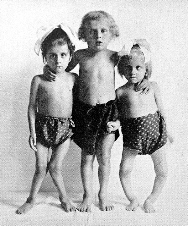 Tres niños con las piernas arqueadas miran a la cámara en una fotografía antigua.