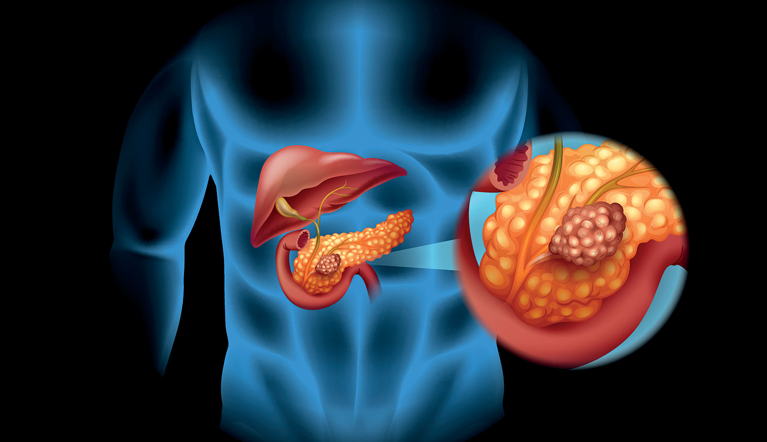 Un páncreas con un tumor dentro del sistema digestivo más amplio.